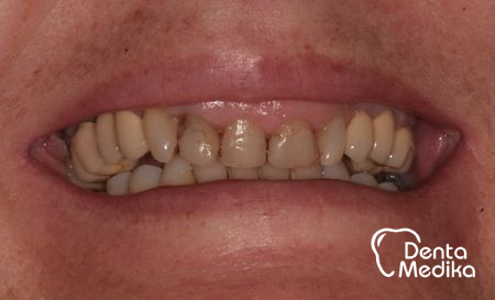 Neestetická dáseň - gummy smile - DentaMedika.cz