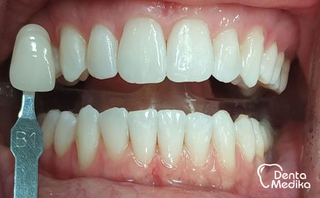 Bělení zubů Brno - DentaMedika.cz