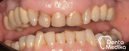 Gummy smile - původní stav - DentaMedika.cz