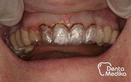 Chirurgická šablona pro redukci dásně - DentaMedika.cz