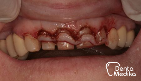 Odstranění dásně - prodloužení zubní korunky - DentaMedika.cz