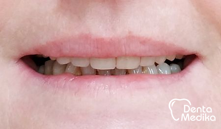 Celokeramické korunky Brno - Dentamedika.cz