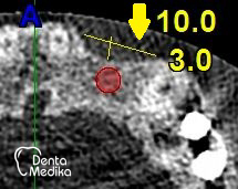 Kostní štěp - rozšíření čelisti před implantací - DentaMedika Brno_1