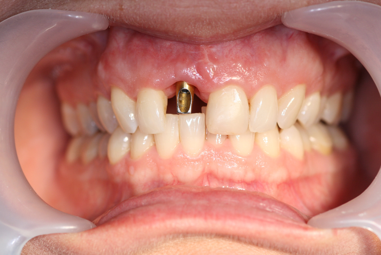Komplikované mezičelistní poměry z hlediska hlubokého skusu a horizontálního úbytku kosti - Implantáty Brno - DentaMedika.cz 
