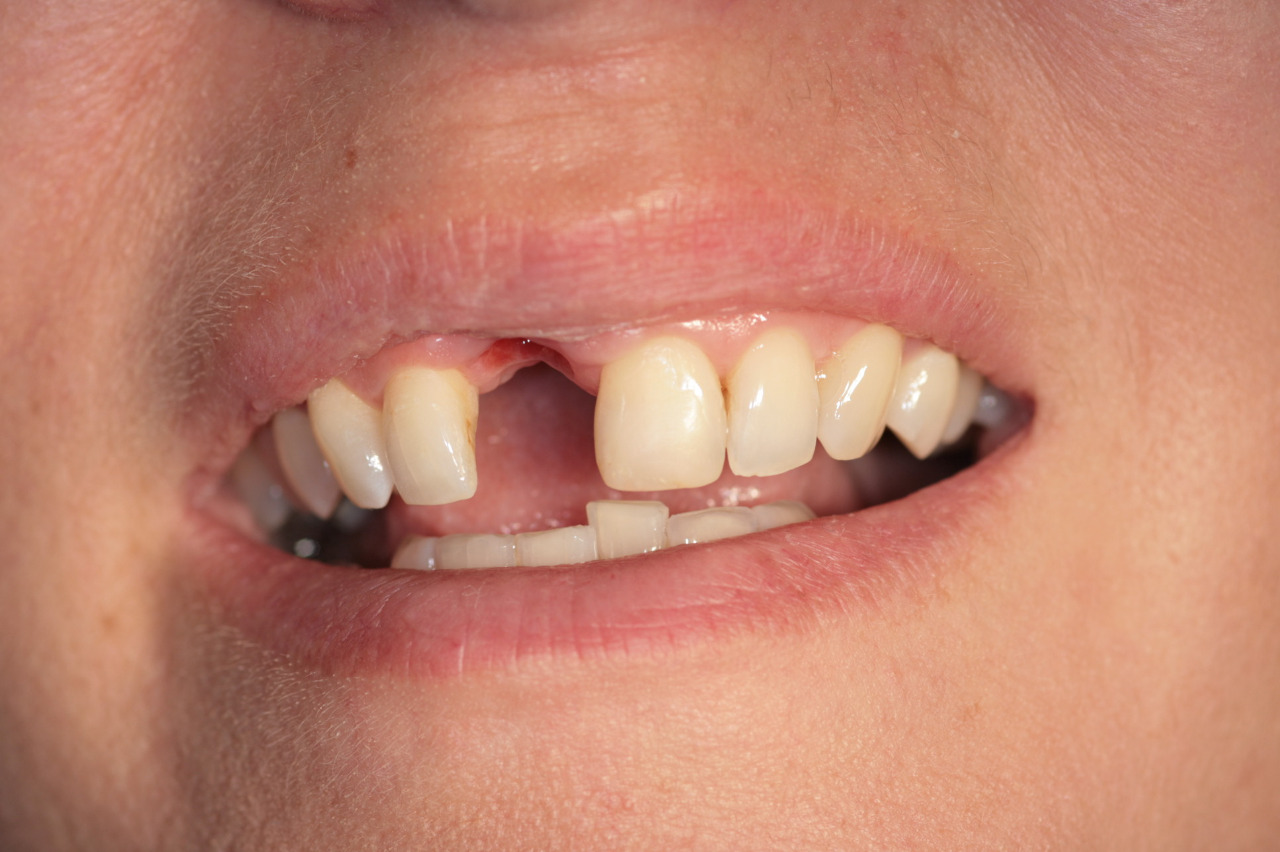 Ztracená horní jednička po zánětlivých komplikacích a resekci kořenového hrotu - Implantáty Brno - DentaMedika.cz