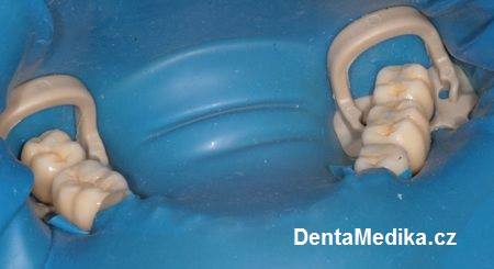 Implantáty zubů Brno - Dentamedika 14_3