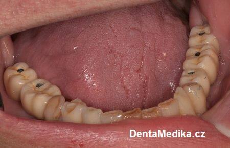 Implantáty zubů Brno - Dentamedika 14_3