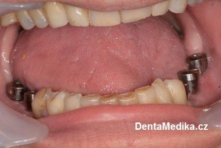 Zubní implantáty Brno - Dentamedika 14_1