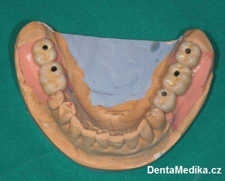Zubní implantáty Brno - Dentamedika.cz 14_2