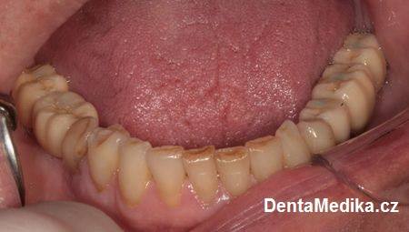 Implantáty zubů Brno - Dentamedika 14_4