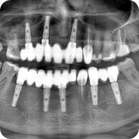 Zubní implantáty Brno - 16