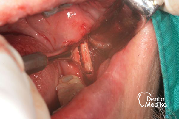 Kostní štěp - rozšíření čelisti před implantací - DentaMedika Brno_2