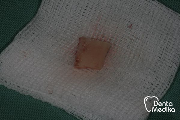 Kostní štěp - rozšíření čelisti před implantací - DentaMedika Brno_3