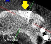Kostní štěp - rozšíření čelisti před implantací - DentaMedika Brno_4