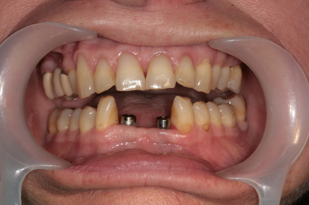Zubní implantáty Brno - Dentamedika.cz - 12_1