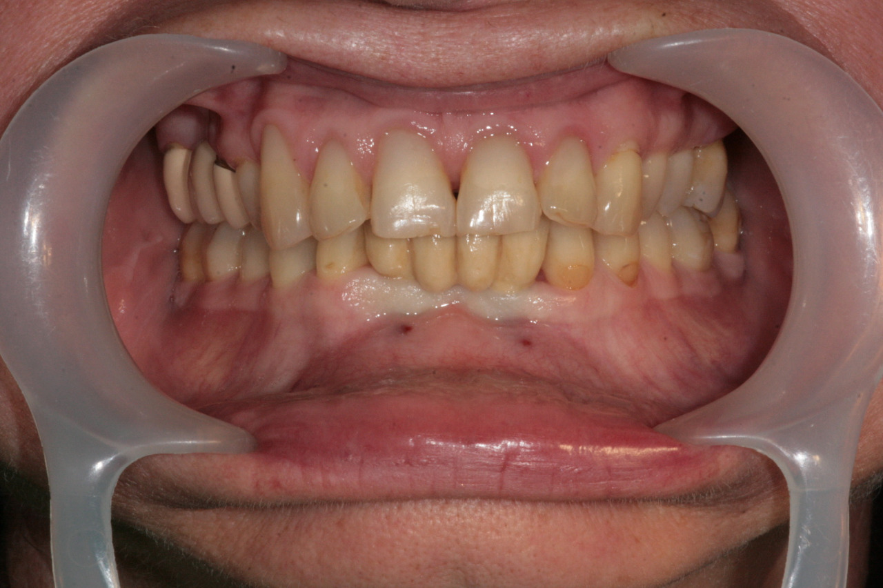 Zubní implantáty Brno - Dentamedika.cz - 12_3