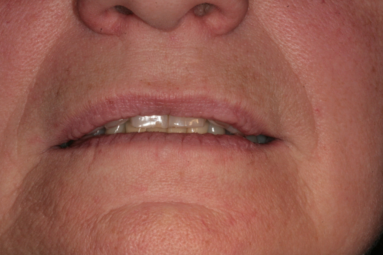 Zubní implantáty Brno - Dentamedika.cz - 12_4
