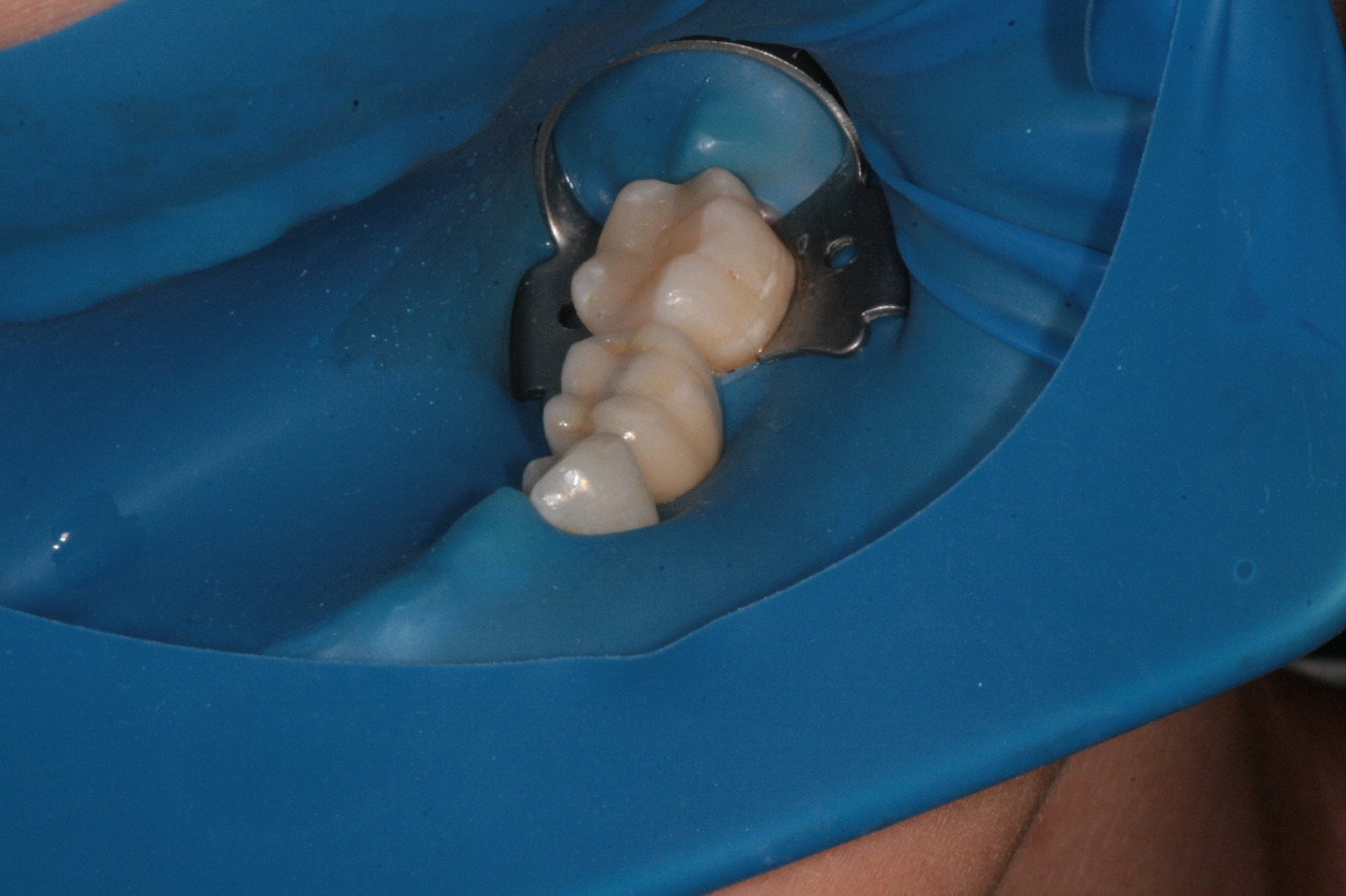 Zubní implantáty Brno - Dentamedika.cz - 13_3
