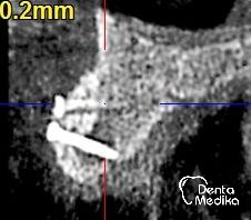 Kostní štěp - rozšíření čelisti před implantací - DentaMedika Brno_5