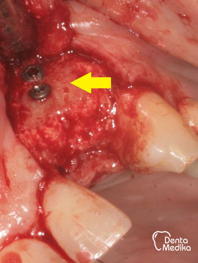 Kostní štěp - rozšíření čelisti před implantací - DentaMedika Brno_7