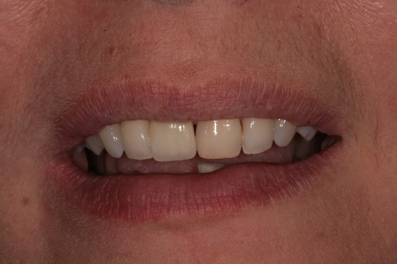 Keramická korunka na implantátu - Implantáty Brno - DentaMedika.cz