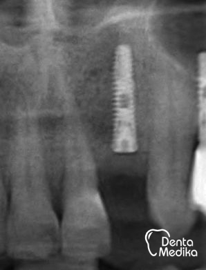 Kostní štěp - rozšíření čelisti před implantací - DentaMedika Brno_8