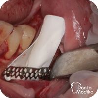 Rozšíření kosti dolní čelisti Dentamedika.cz Brno