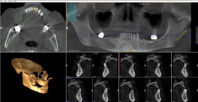 Zubní rentgen - CT - implantáty Brno