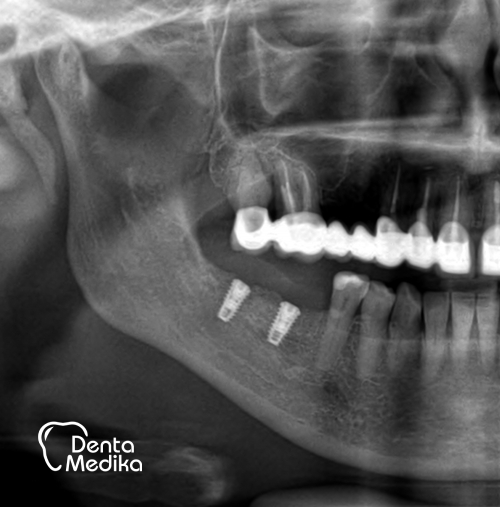 Doplnění kosti čelisti před implantací Brno 012