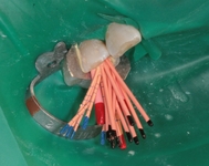 Endodoncie - laterální kondenzace