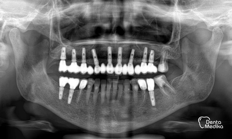 Komplexní ošetření chrupu s mnohočetnými implantacemi Brno