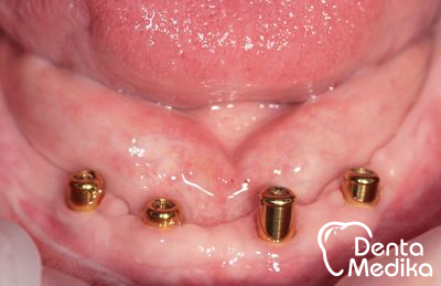 Hybridní náhrada na implantátech - Zubní Brno 3
