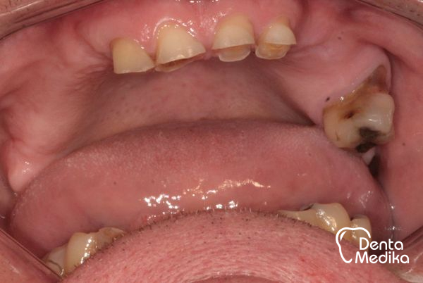 Implantáty zubů Brno - Dentamedika_cz - 17_1