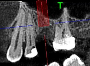 Sinus lift Brno - implantáty x3