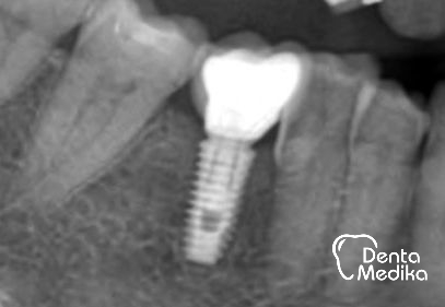 Split čelistní kosti před implantací - DentaMedika Brno _7 po půl roce