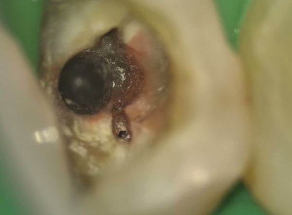 Chyby v endodoncii