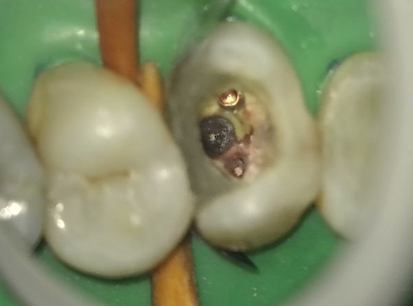 Chyby v endodoncii  - oprava