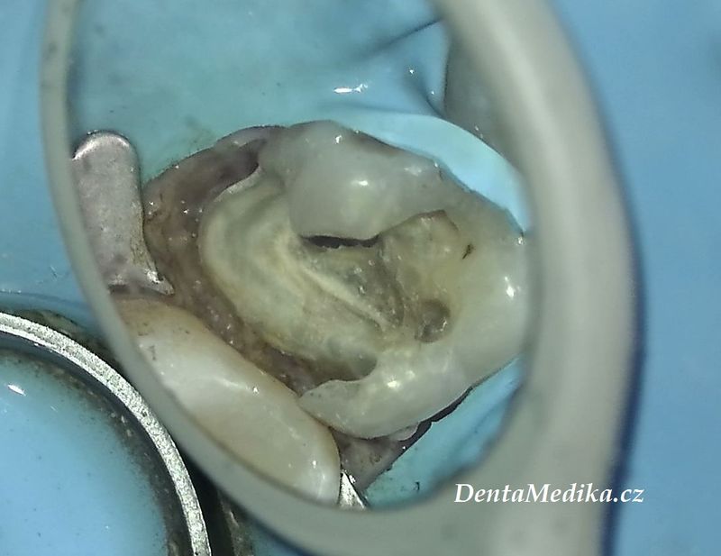 Zubní chirurgie Brno - VFP - Dentamedika.cz _3