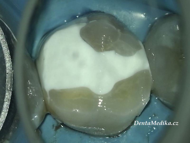 Zubní chirurgie Brno - VFP - Dentamedika.cz _6