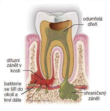 Odumřelý zub