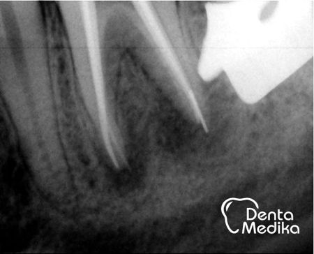 Reendodoncie - zalomený nástroj v kosti 1
