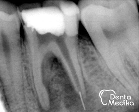 Reendodoncie - zalomený nástroj v kosti 2