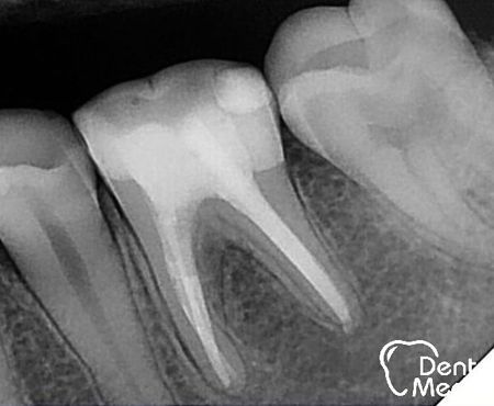 Reendodoncie - zalomený nástroj v kosti 3