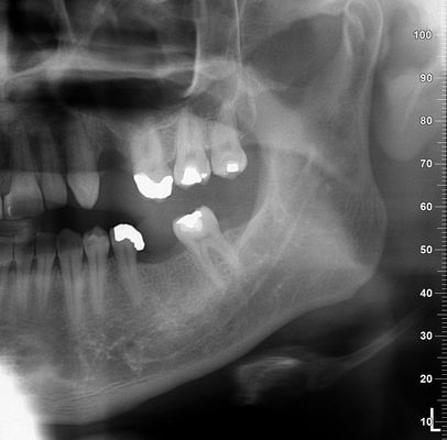 Sinus lift Brno - Zubní implantáty 1_2