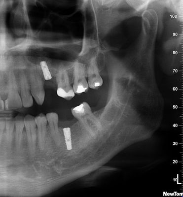 Sinus lift Brno - Zubní implantáty 1_3