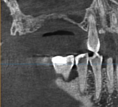 Sinus lift Brno - Zubní implantáty 2_1