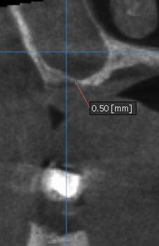 Sinus lift Brno - Zubní implantáty 2_2
