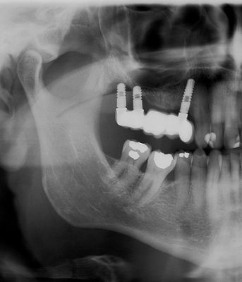 Sinus lift Brno - Zubní implantáty 3_1