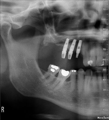Sinus lift Brno - Zubní implantáty 3_2