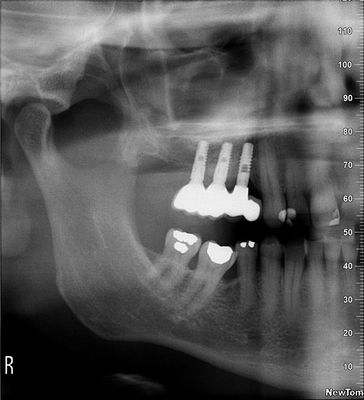 Sinus lift Brno - Zubní implantáty 3_3